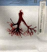 Intact Blood Clot That Was Attached To The ETT Of A Terminally Extubated Covid Patient.